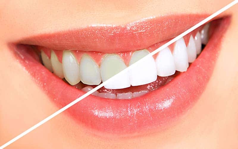 چه زمانی به‌جای لمینت، از بلیچینگ دندان استفاده می‌شود؟