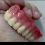 دندان مصنوعی طرح لمینیت