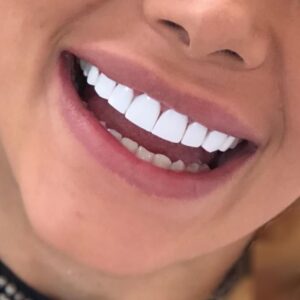 کامپوزیت ونیر زیبایی دندان