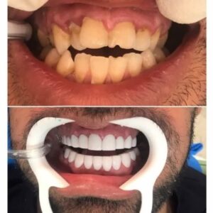 خدمات ایمپلنت دندان کامپوزیت لمینت دست دندان مصنوعی