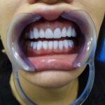 کامپوزیت ونیر زیبایی دندان