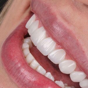 خدمات کامپوزیت دندان ایمپلنت دندان عصبکشی