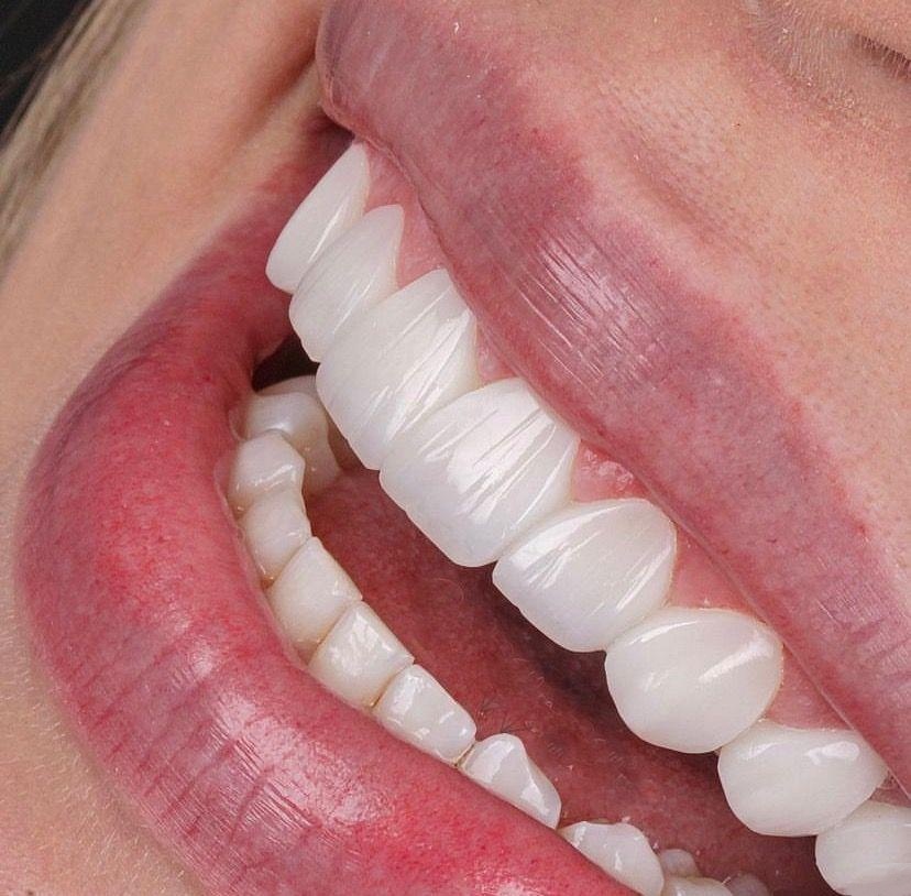 خدمات کامپوزیت دندان ایمپلنت دندان عصبکشی