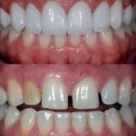 کامپوزیت دندان در زیتون کارمندی اهواز