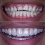 کامپوزیت دندان در زیتون کارمندی اهواز