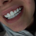 کامپوزیت دندان در نادری اهواز
