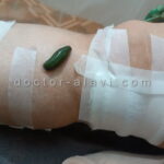 برداشتن خال با لیزر در شرق تهران